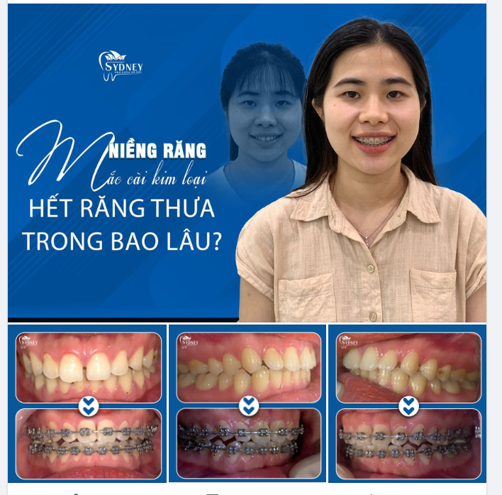 NIỀNG RĂNG CẢI THIỆN RĂNG THƯA KHOẢNG BAO LÂU?