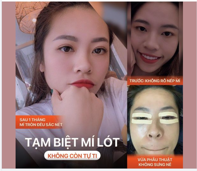 CẮT MÍ "BỎ" DA - TRẺ RA VÀI TUỔI
