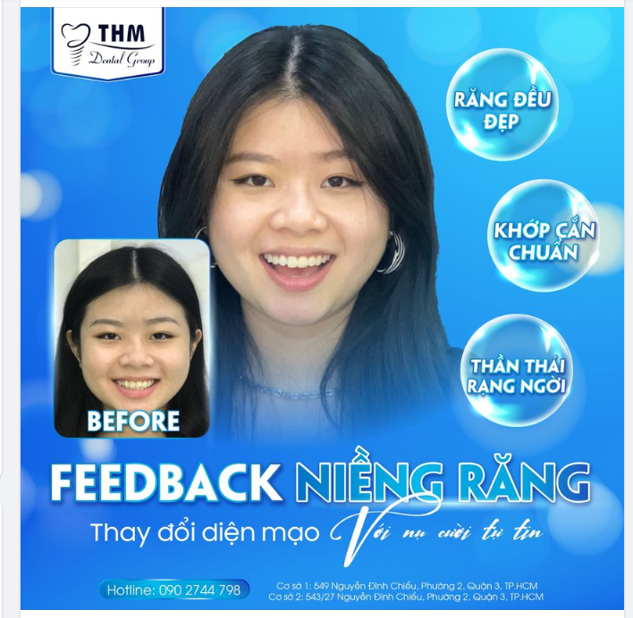 THAY ĐỔI DIỆN MẠO VỚI NỤ CƯỜI TỰ TIN NHỜ NIỀNG RĂNG TẠI NHA KHOA THẾ HỆ MỚI