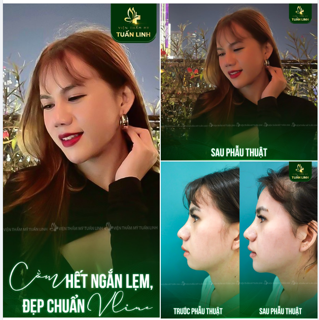 Cằm hết ngắn lẹm - Đẹp chuẩn VLine