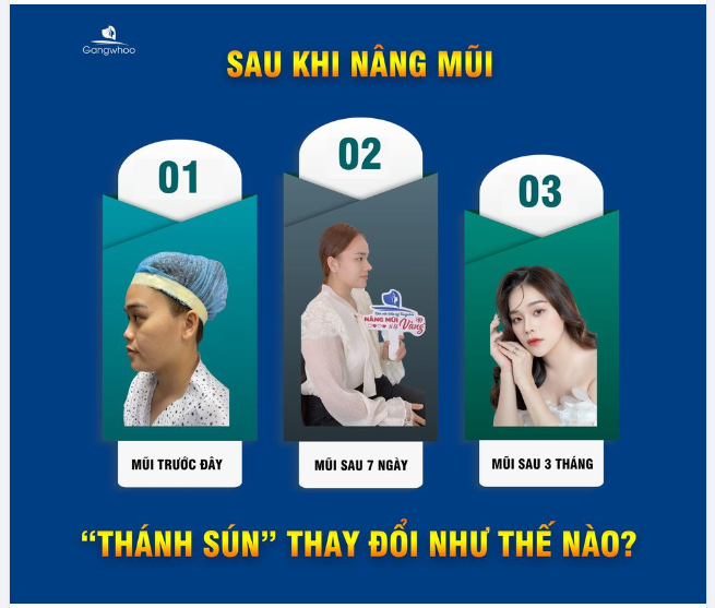 SAU KHI NÂNG MŨI - "THÁNH SÚN" NGÂN THẢO THAY ĐỔI NHƯ THẾ NÀO?