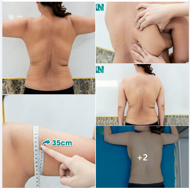 ĐỢT 2: HÚT MỠ TẠO DÁNG THẨM MỸ VÙNG CÁNH TAY, LƯNG VÀ NÁCH CHO CHỊ KH VIỆT KIỀU ĐỨC. TRỞ LẠI BỆNH VIỆN SAU 4 NĂM HÚT MỠ BỤNG. TRỰC TIẾP 15H00 HÔM NAY