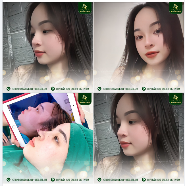 Nâng mũi xong mà XINH thế này thì làm ngay đi thôi ạ!!