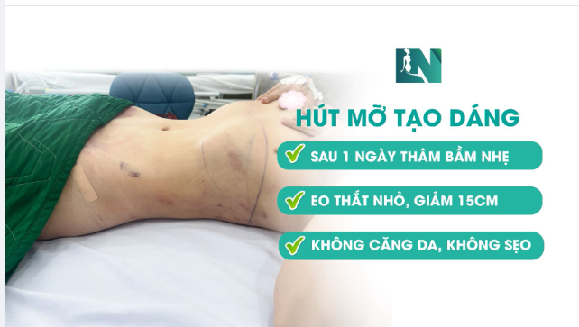 SAU 1 NGÀY HÚT MỠ TẠO DÁNG THẨM MỸ - DÁNG VÓC RA SAO?