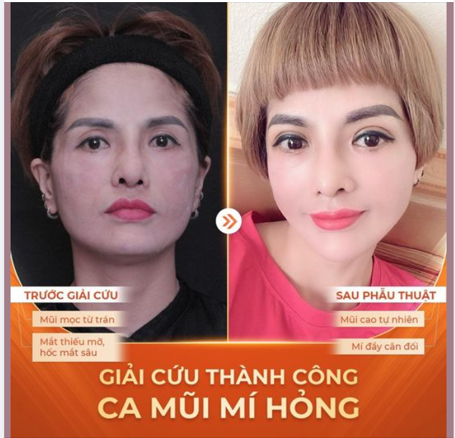 "GIẢI CỨU" MŨI MÍ HỎNG - HỒI SINH NHAN SẮC TRONG "TÍCH TẮC"