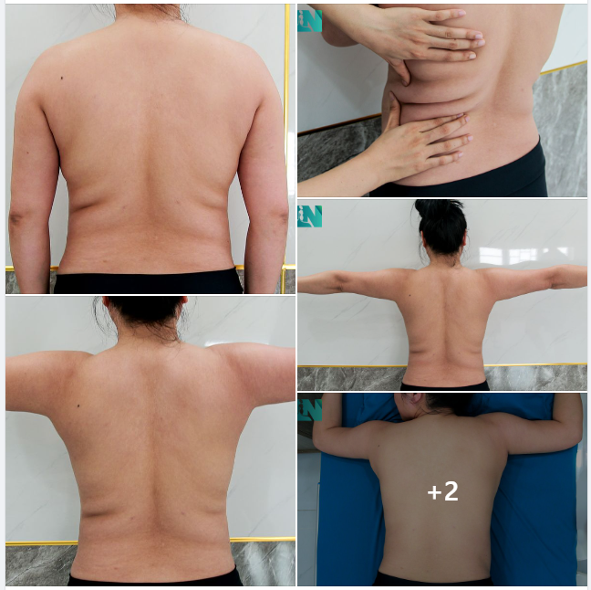 ĐỢT 1: HÚT MỠ TẠO DÁNG THẨM MỸ VÙNG CÁNH TAY, LƯNG VÀ NÁCH CHO CHỊ KH VIỆT KIỀU MỸ, NHIỀU HƠN 2 LẦN HÚT MỠ NHƯNG DÁNG VẦN SỒ SỀ. TRỰC TIẾP 16H00 HÔM NAY.