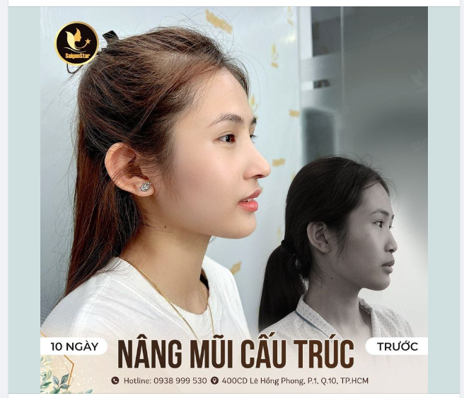 ĐẸP NGAY SAU 10 NGÀY NÂNG MŨI