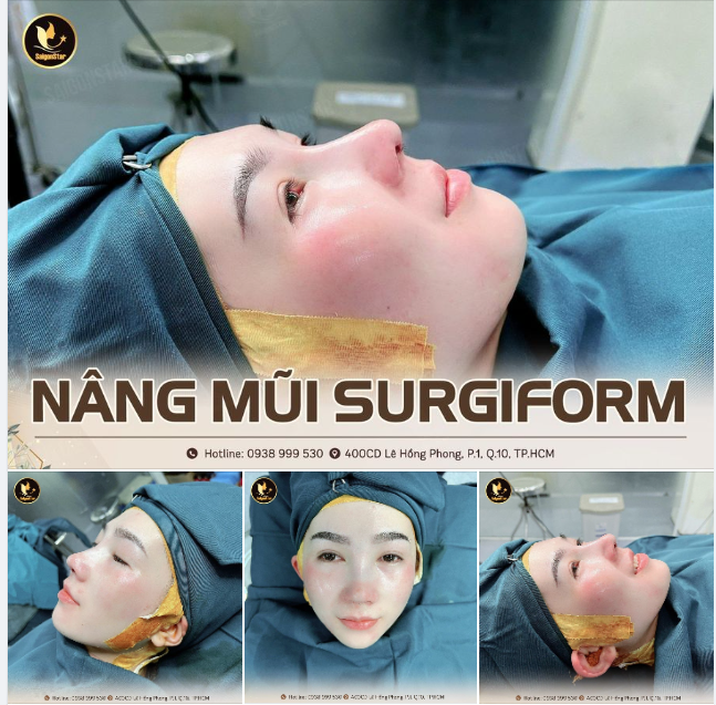 XINH ĐẸP HƠN NHỜ NÂNG MŨI SURGIFORM