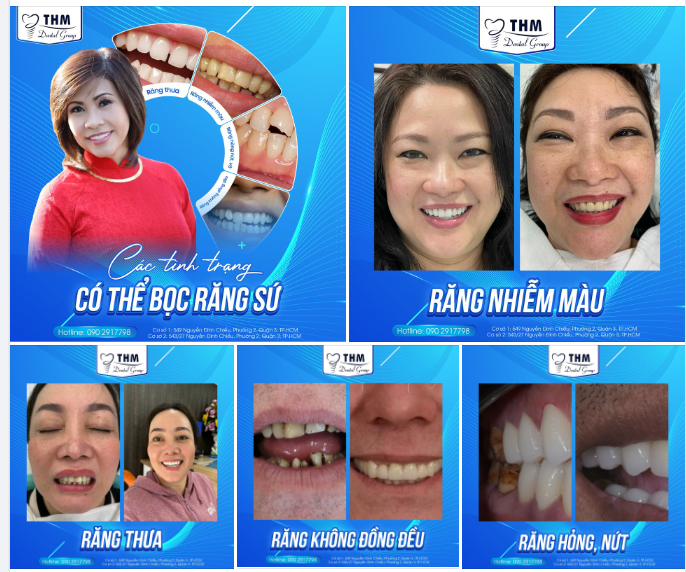 THẨM MỸ RĂNG SỨ TẠI NHA KHOA THẾ HỆ MỚI - XỬ LÝ MỌI TÌNH TRẠNG RĂNG