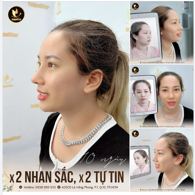 NÂNG MŨI DR. HOẠT  X2 NHAN SẮC – X2 TỰ TIN