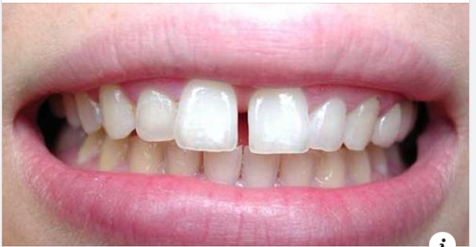 Khắc phục khe hở giữa hai răng cửa