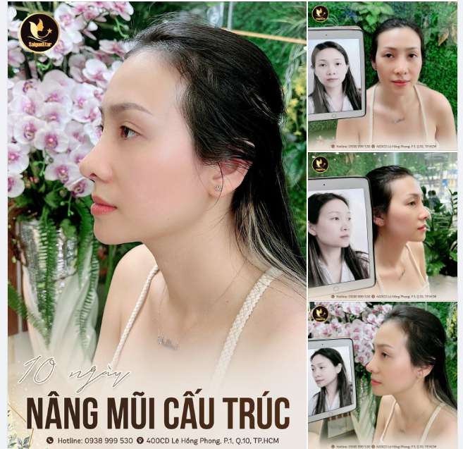 KHÁCH HÀNG XINH ĐẸP SAU 10 NGÀY NÂNG MŨI CẤU TRÚC DR. HOẠT