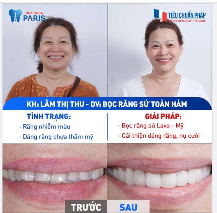 Bọc răng sứ có giúp vừa trẻ vừa sang?