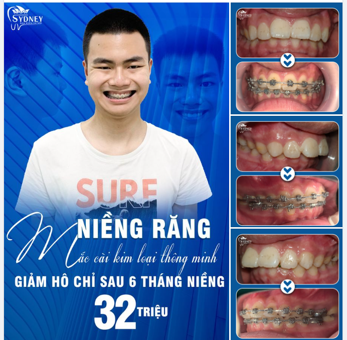 VÌ SAO BẠN NÊN CHỌN PHƯƠNG PHÁP NIỀNG RĂNG HÔ NGAY?
