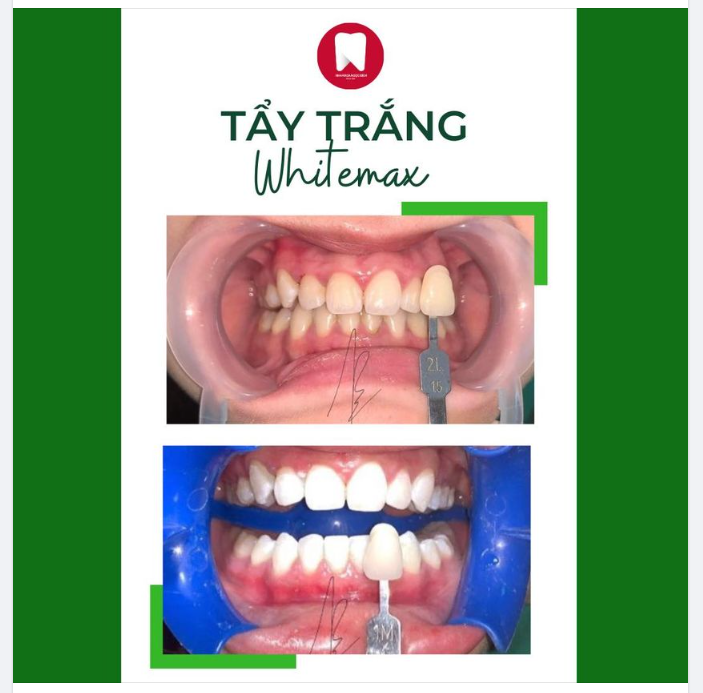 RĂNG KHÔNG ĐỀU VÀNG, Ố VÀNG KHIẾN MÌNH KÉM TỰ TIN