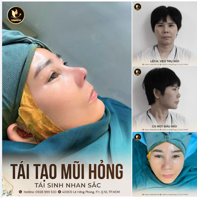 TÁI TẠO MŨI HỎ.NG – TÁI SINH NHAN SẮC