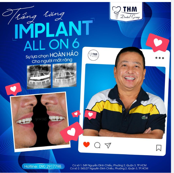 TRỒNG RĂNG IMPLANT ALL ON 6 - SỰ LỰA CHỌN HOÀN HẢO CHO NGƯỜI MẤT RĂNG