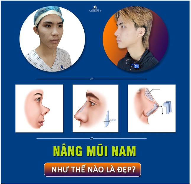 NAM GIỚI NÂNG MŨI - TIÊU CHUẨN NHƯ NÀO LÀ ĐẸP?