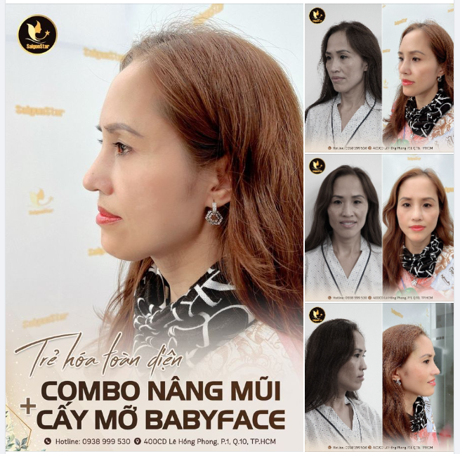 TRẺ HÓA TOÀN DIỆN CÙNG COMBO: NÂNG MŨI + CẤY MỠ BABYFACE