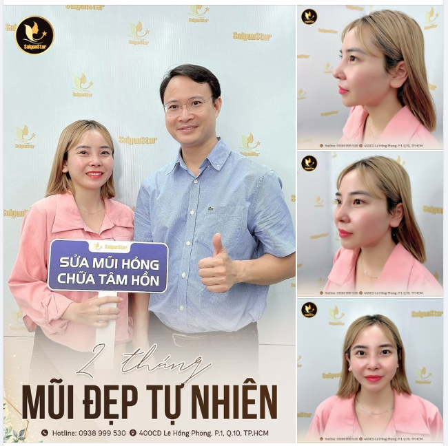 2 THÁNG MŨI ĐẸP TỰ NHIÊN