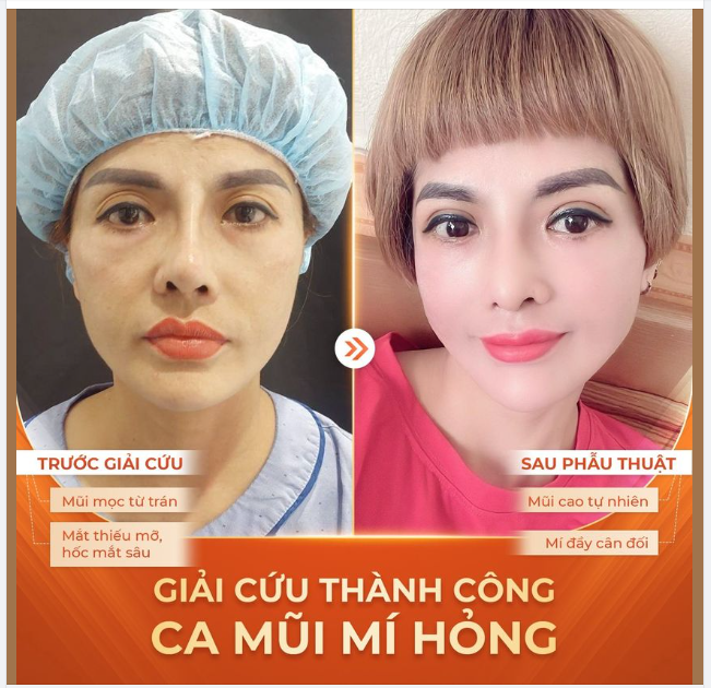 "GIẢI CỨU" MŨI MÍ HỎNG - HỒI SINH NHAN SẮC TRONG "TÍCH TẮC"