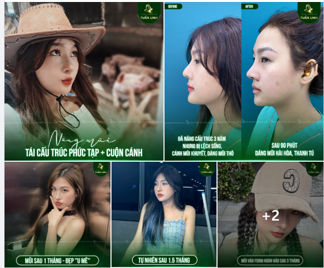 Nâng mũi cấu trúc 3 năm tại nơi khác nhưng không ưng ý  - Và kết quả sau 3 tháng nâng lại tại Tuấn Linh!!