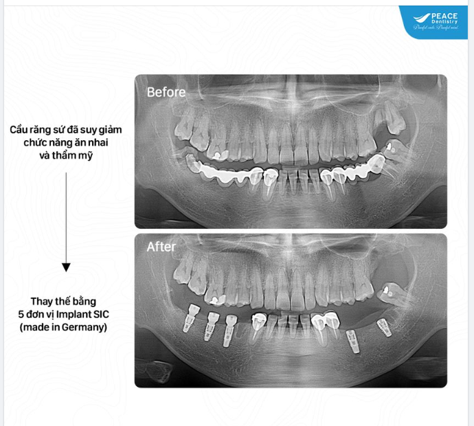 Những thập niên trước, khi Implant chưa phổ biến tại Việt Nam thì cầu răng sứ (hoặc hàm nhựa tháo lắp) vẫn là lựa chọn chủ yếu khi mất răng.