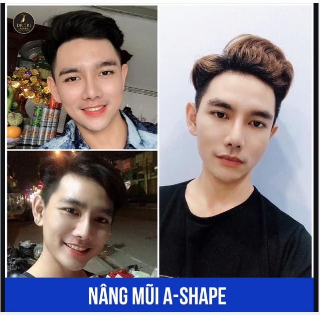 ĐẸP TRAI HƠN SAU 3 NĂM NÂNG MŨI ASHAPE