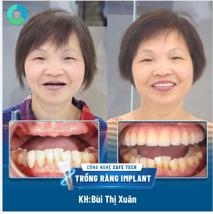 TRỞ VỀ VIỆT NAM TRỒNG RĂNG IMPLANT TOÀN HÀM VÀ NHẬN KẾT QUẢ NHƯ Ý
