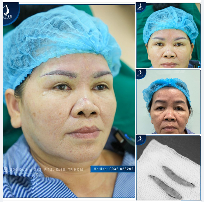 NÂNG CUNG MÀY - Cứu cánh cho đôi mắt lão hóa