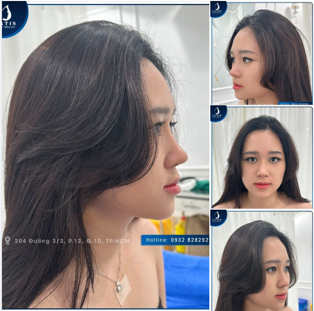 Mũi bán cấu trúc 10 ngày đẹp trọn “10 điểm” và KHÔNG CÓ NHƯNG