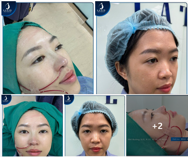 Mũi thấp nhưng thích dáng cao thì...