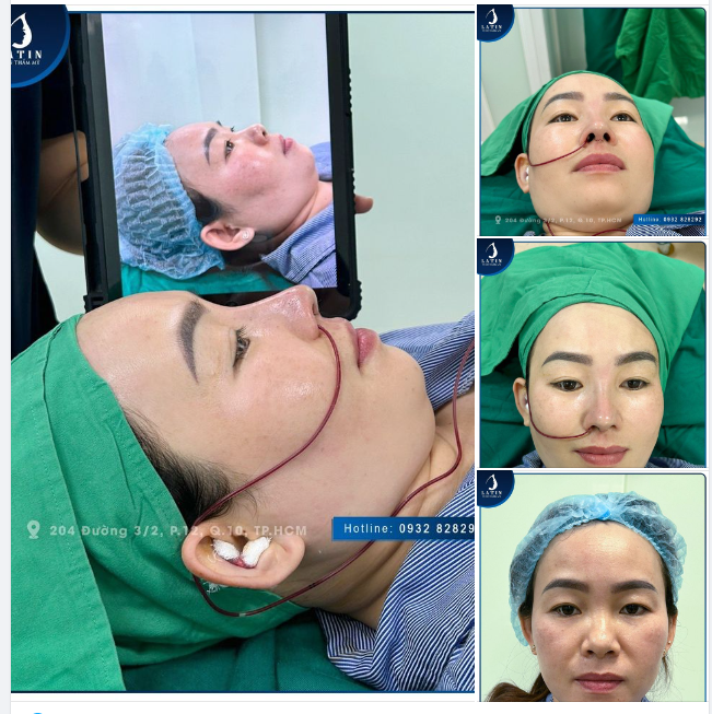 Lên dáng mũi tự nhiên nhẹ nhàng cho chị khách U30