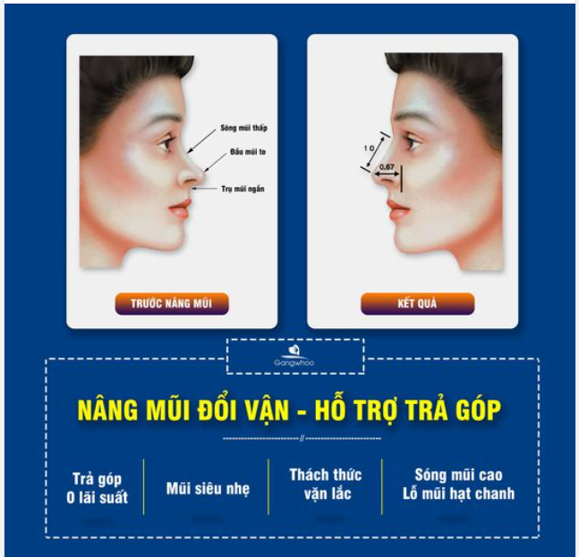 NÂNG MŨI ĐỔI VẬN - HỖ TRỢ TRẢ GÓP NÂNG MŨI TẠI NHÀ GANGWHO0 CÓ GÌ MỚI?