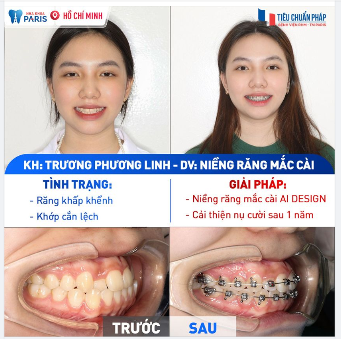 Kết quả niềng răng ấn tượng của KH Trương Phương Linh sau 1 năm!
