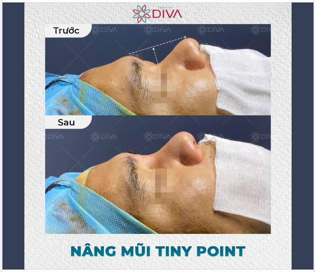 SÓNG MŨI THẤP, GÃY NGANG MẮT – GIẢI PHÁP LÀ GÌ?