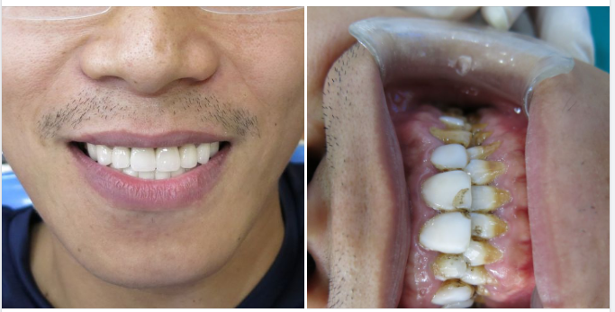 Cách Chăm Sóc Để Răng Sứ Tồn Tại Lâu Dài Hơn