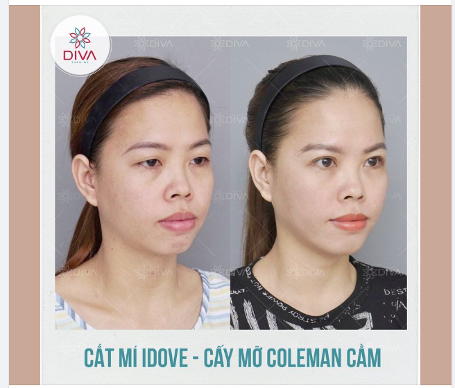 CẢI THIỆN CẰM LẸM, MÍ LÓT, MẮT NHỎ - GƯƠNG MẶT TƯƠI TRẺ, THU HÚT SAU THẨM MỸ