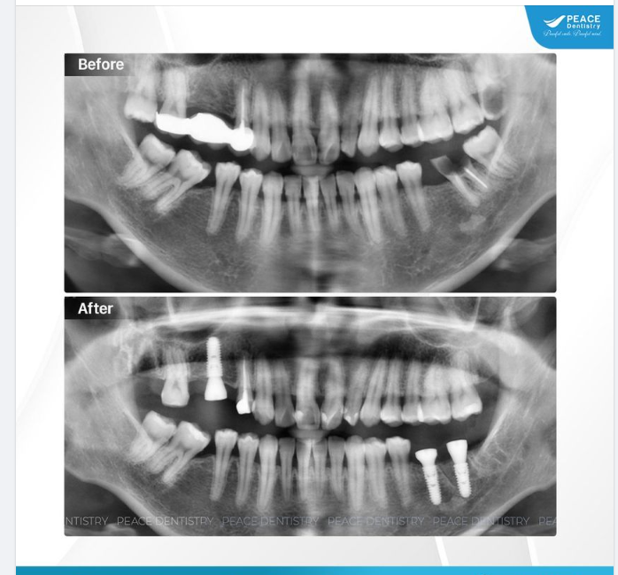 Ca lâm sàng: thay cầu răng sứ kém chất lượng bằng Implant vững ổn