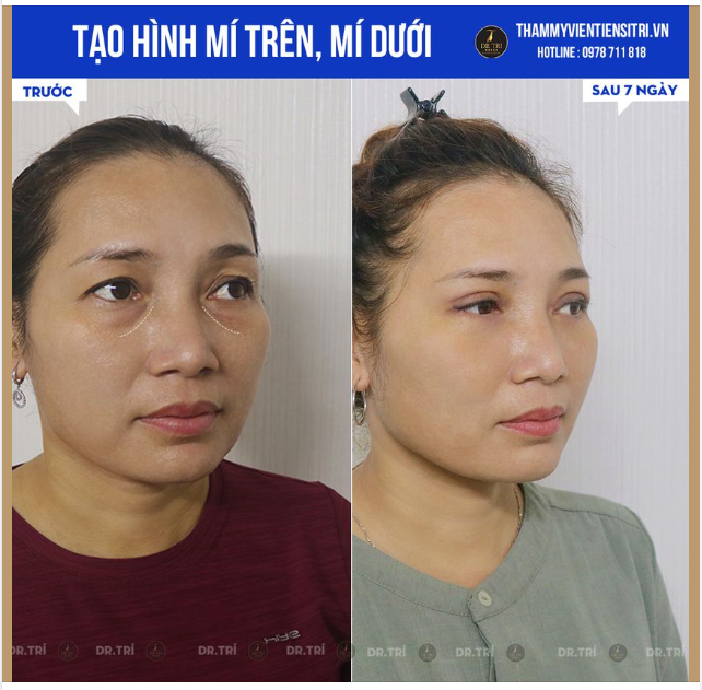 XÓA TAN BỌNG MỠ - TRẺ HÓA VÙNG MẮT