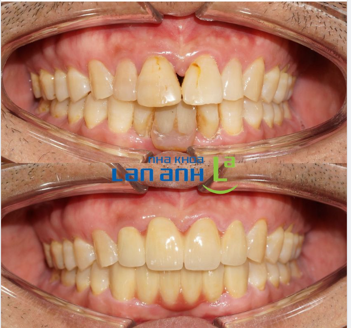 Hình ảnh điều trị trước và sau khi làm 4-6 răng sứ phía trước của bác sĩ Lan, chi nhánh 149 Tôn Dật Tiên, Q7!