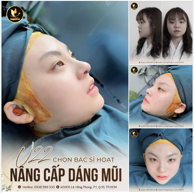 U22 CHỌN BÁC SĨ HOẠT NÂNG CẤP DÁNG MŨI