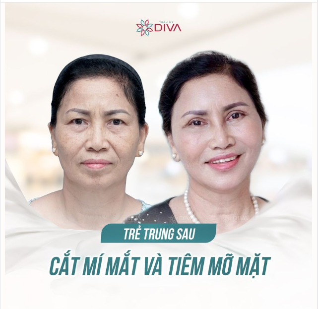 TRẺ TRUNG SAU CẮT MÍ MẮT VÀ TIÊM MỠ COLEMAN MẶT