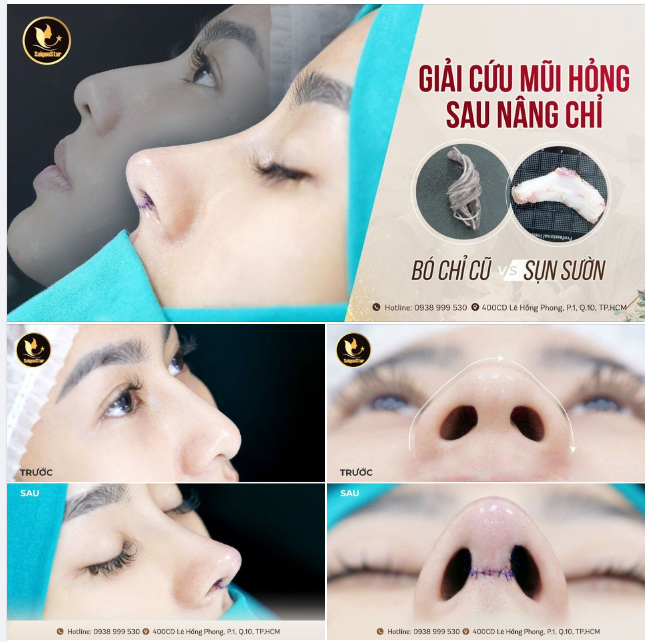 60 PHÚT NÂNG MŨI SỬA LẠI | ĐẸP TỰ NHIÊN NHƯ LẦN ĐẦU