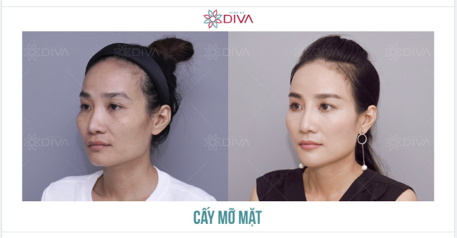 KẾT QUẢ TIÊM MỠ COLEMAN MẶT: THẦN THÁI TRẺ TRUNG THU HÚT