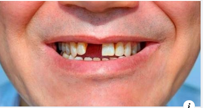 Không trồng răng giả sau khi nhổ răng có sao không?
