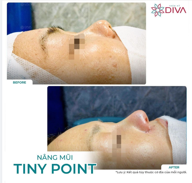 KẾT QUẢ NÂNG MŨI TINY POINT: MŨI CAO TỰ NHIÊN CÂN ĐỐI
