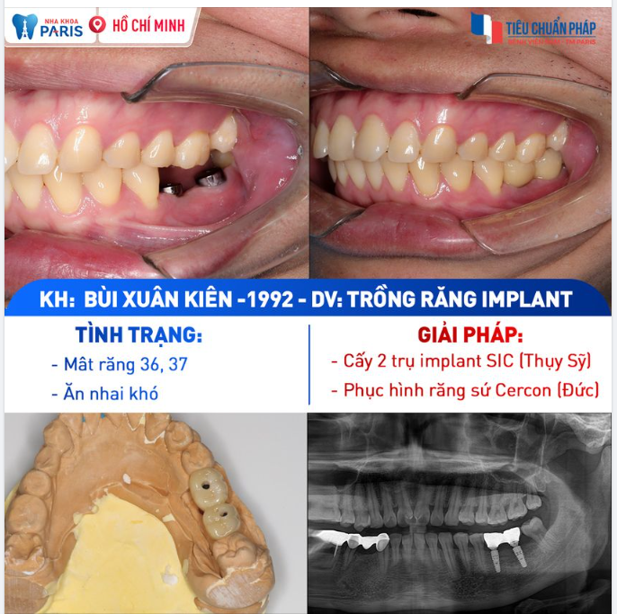 Người trẻ càng ngày càng quan tâm đến việc trồng răng sớm!