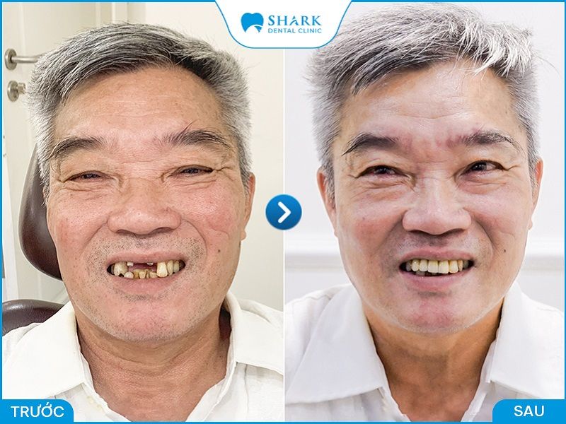 Hình ảnh khách hàng trước và sau khi cấy ghép Implant tại nha khoa Shark