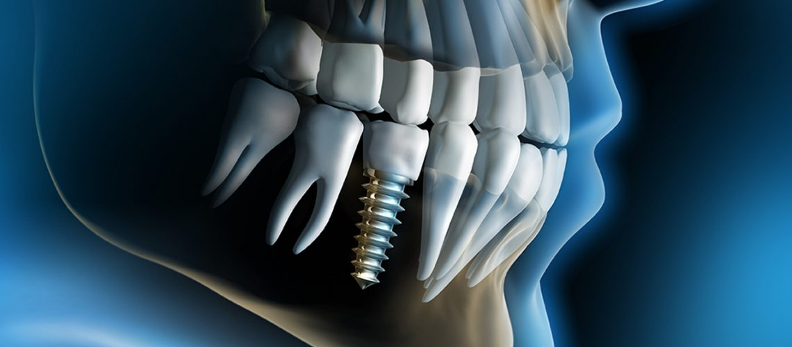 Trụ Implant được cấy ghép trực tiếp vào trong xương hàm đóng vai trò của 1 chiếc chân răng thực thụ